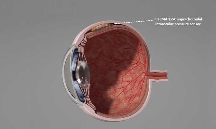 Image of inner eye with implant