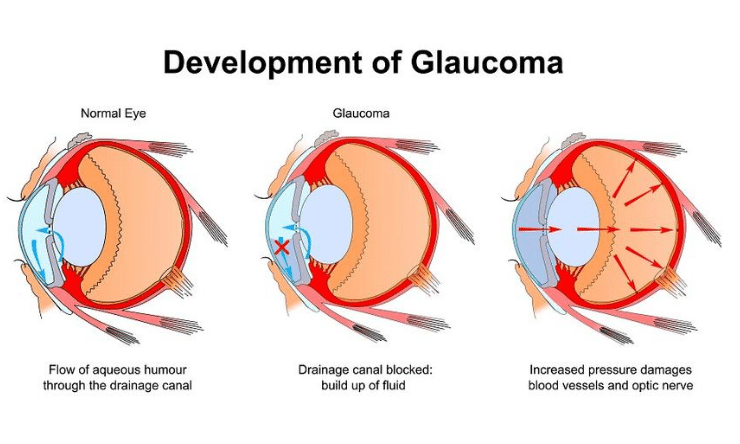 Illustration of eye throughout stages of glaucoma development