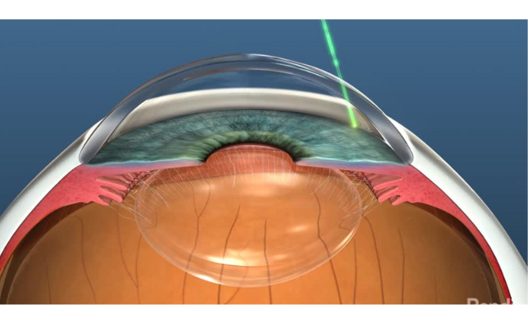 A computer generated graphic showing a cross section of the human eye with a laser targeting the trabecular meshwork.