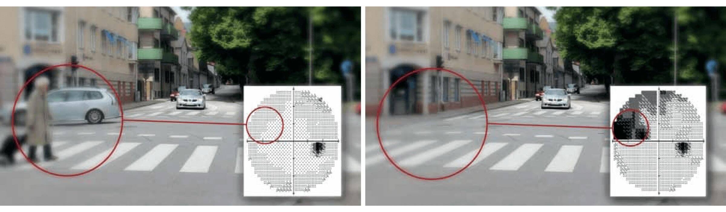 Side-by-side images one showing a person crossing a pedestrian crossing the other showing the filling-in-effect caused by glaucomatous visual field loss. On the second image you can see the pedestrian crossing but not the person crossing it.