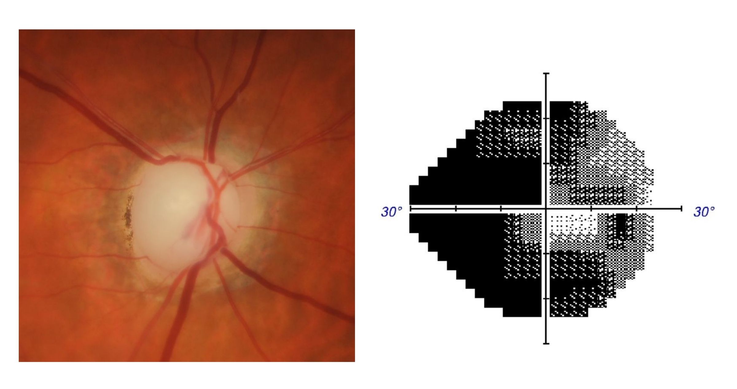 image of advanced Disc photo visual and Field test results