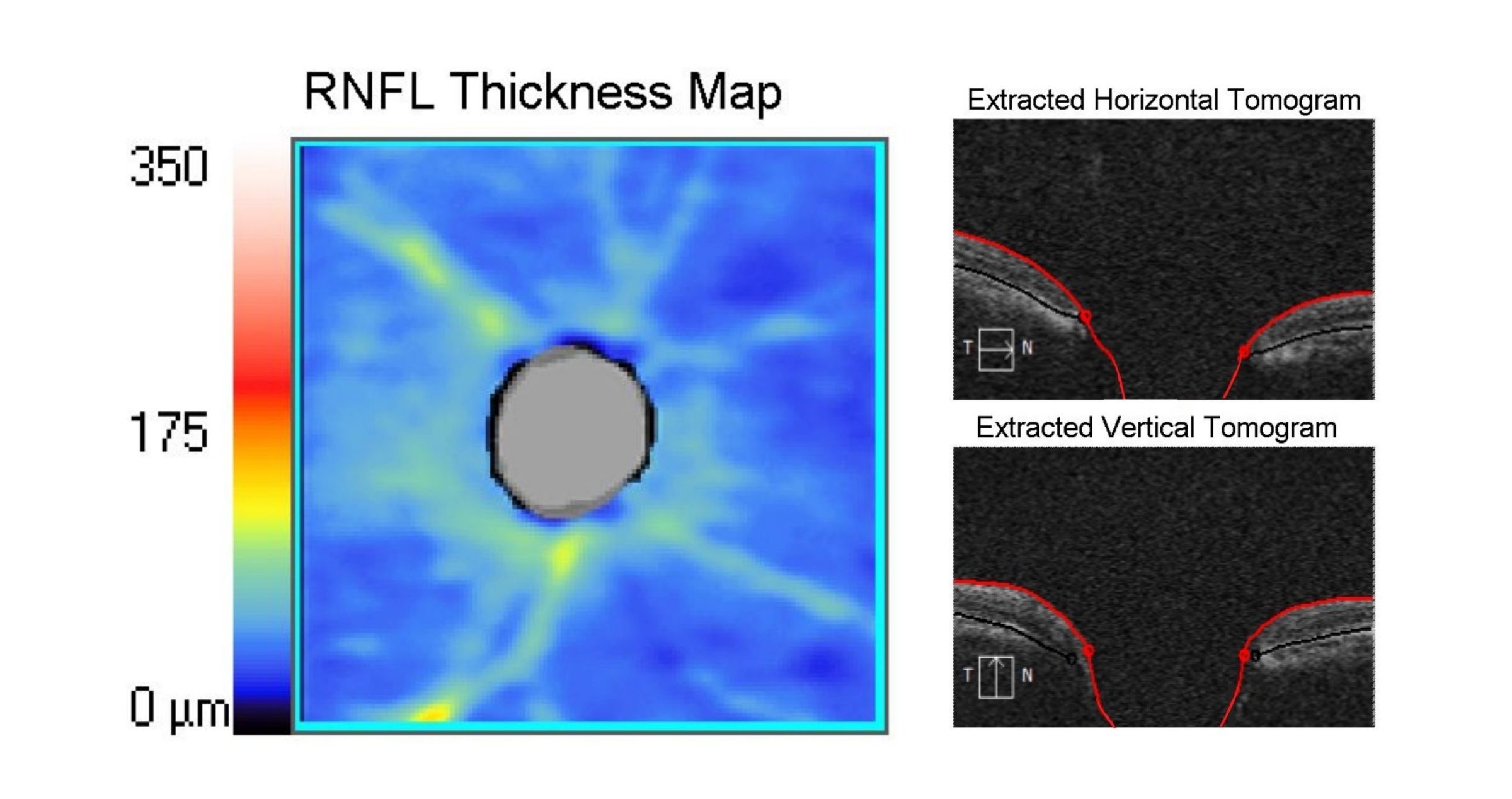 image of Advanced Retinal Nerve Fibre Layer