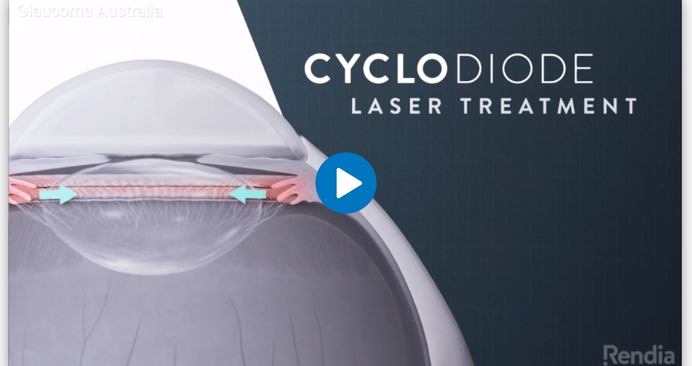Cyclodiode Laser 