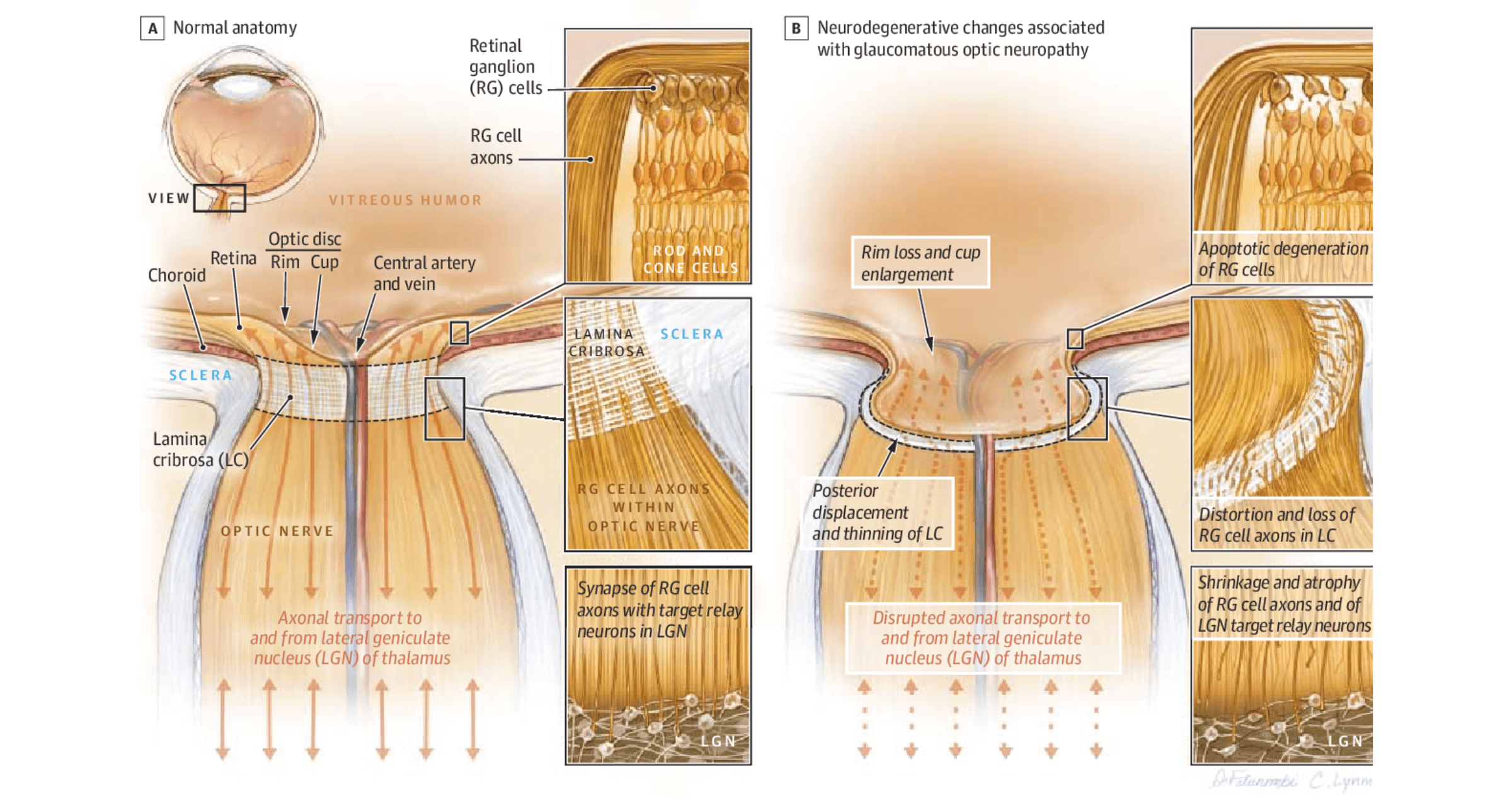 An illustration of the optic nerve showing normal anatomy vs neurodegenerative changes