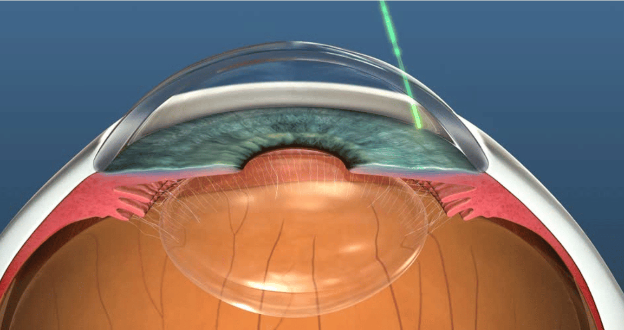 A computer generated graphic showing a cross-section of the human eye with a laser targeting the trabecular meshwork.