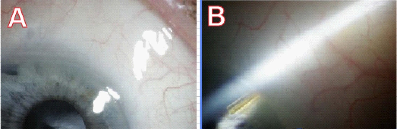 Images of eye after procedure