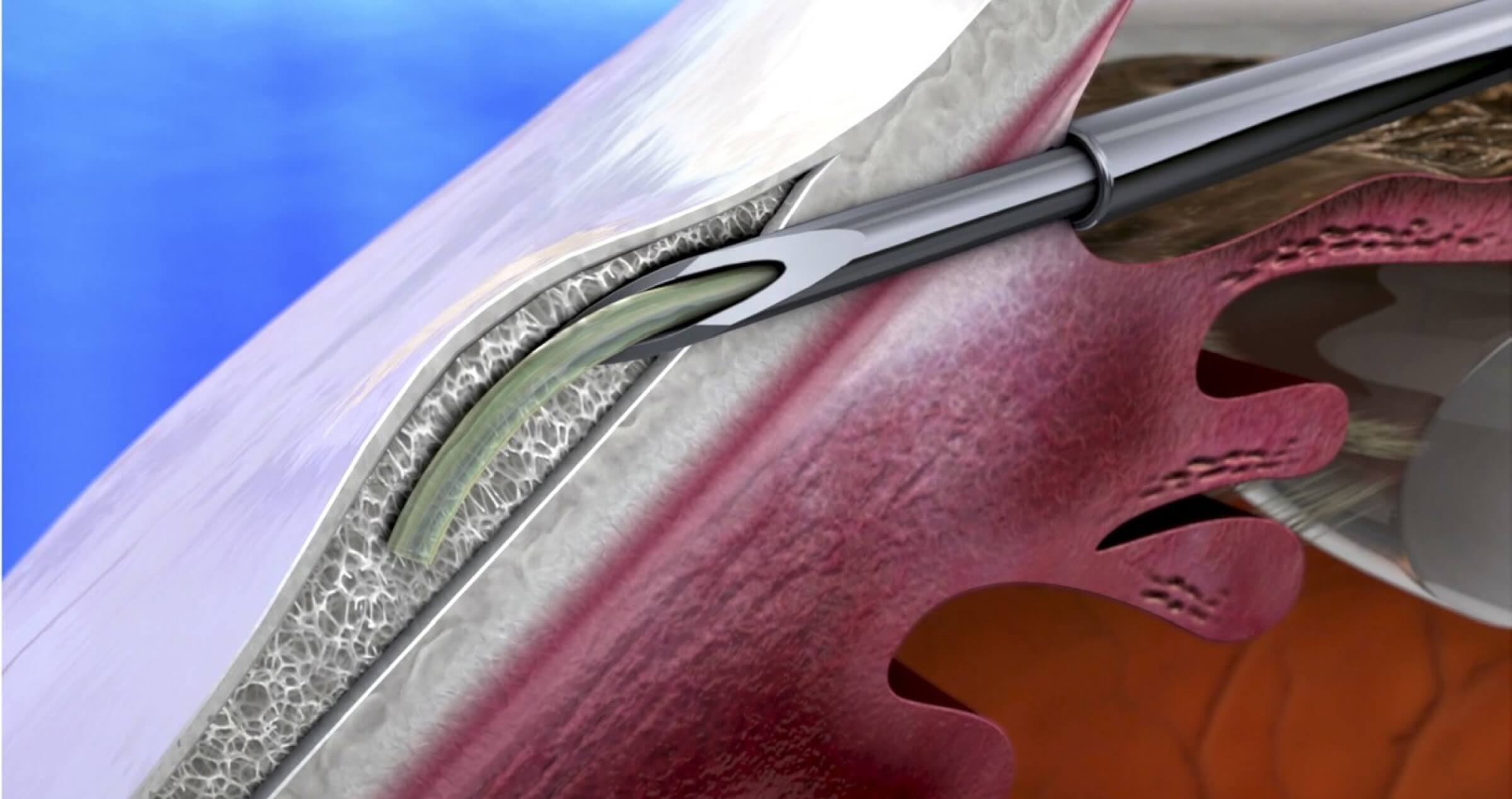 An illustrative cross section of the eye showing the Xen Gel Stent being implanted under the conjunctiva of the eye, 