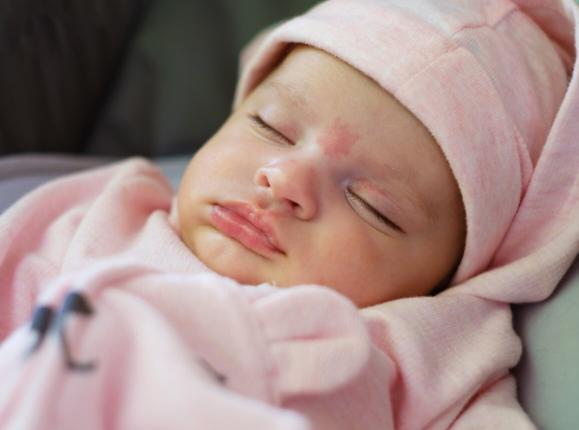 Sleeping baby girl with a port-wine stain birthmark on her forehead