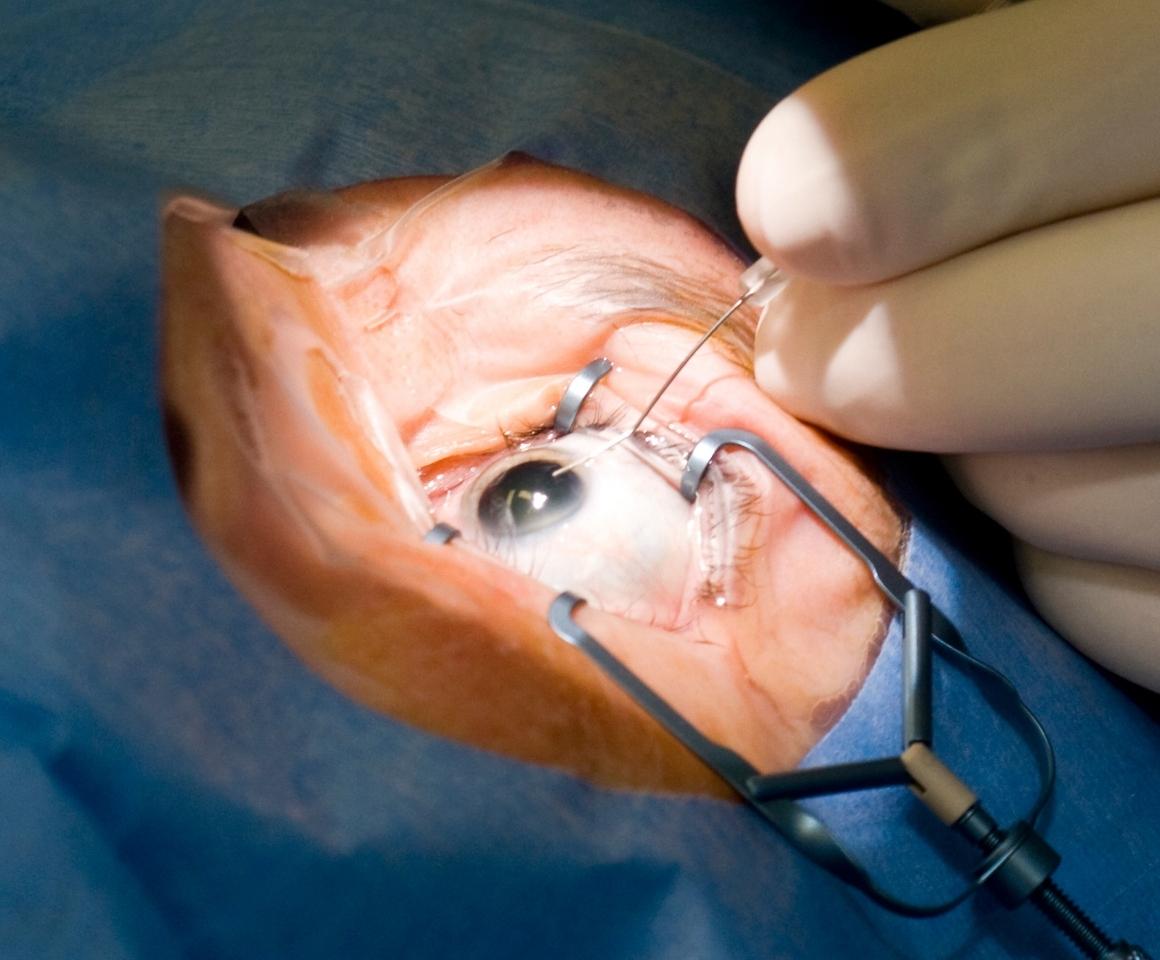 Close up of surgeons preparing eye for surgery