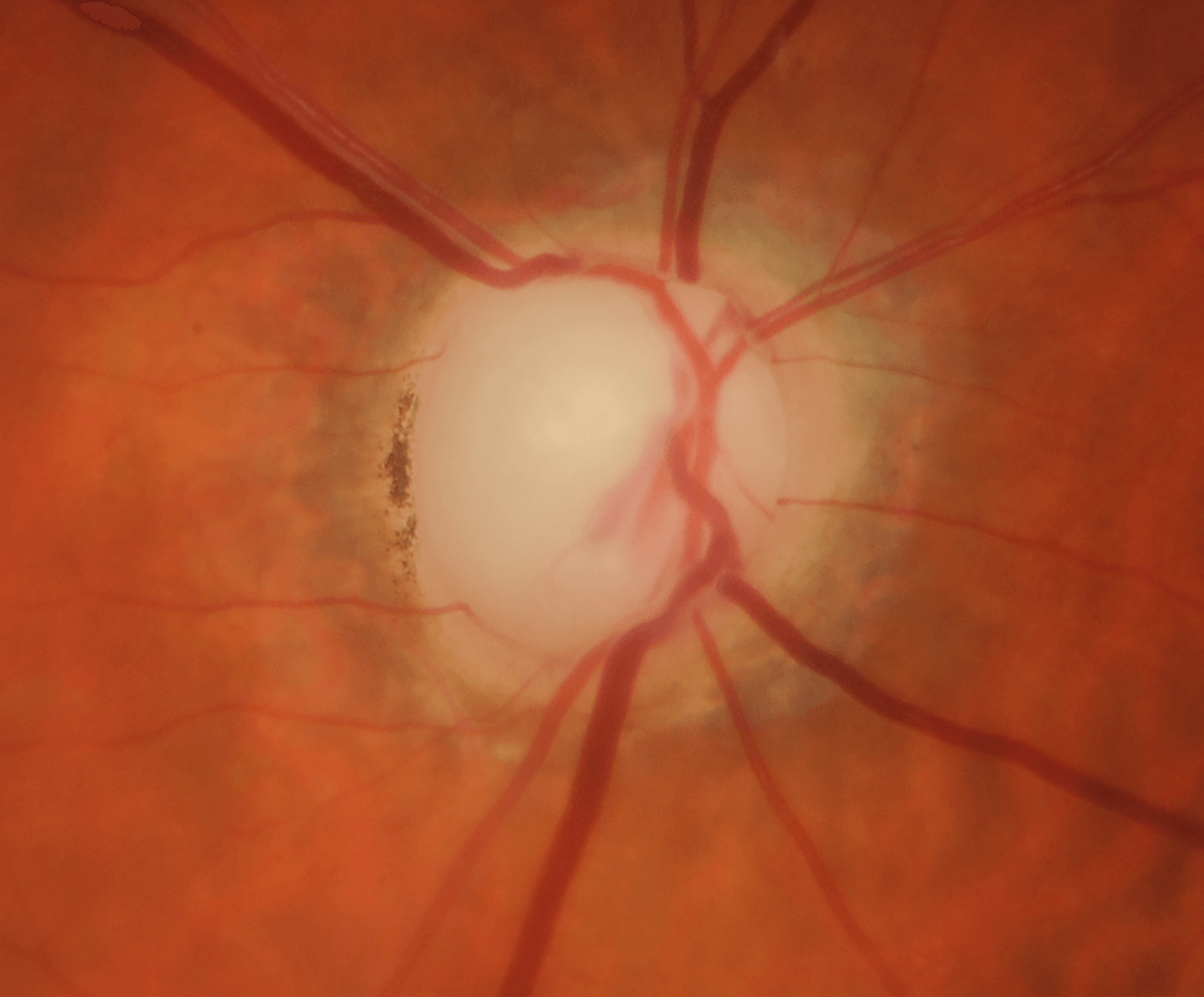 Photo of an optic nerve showing signs of advanced glaucoma