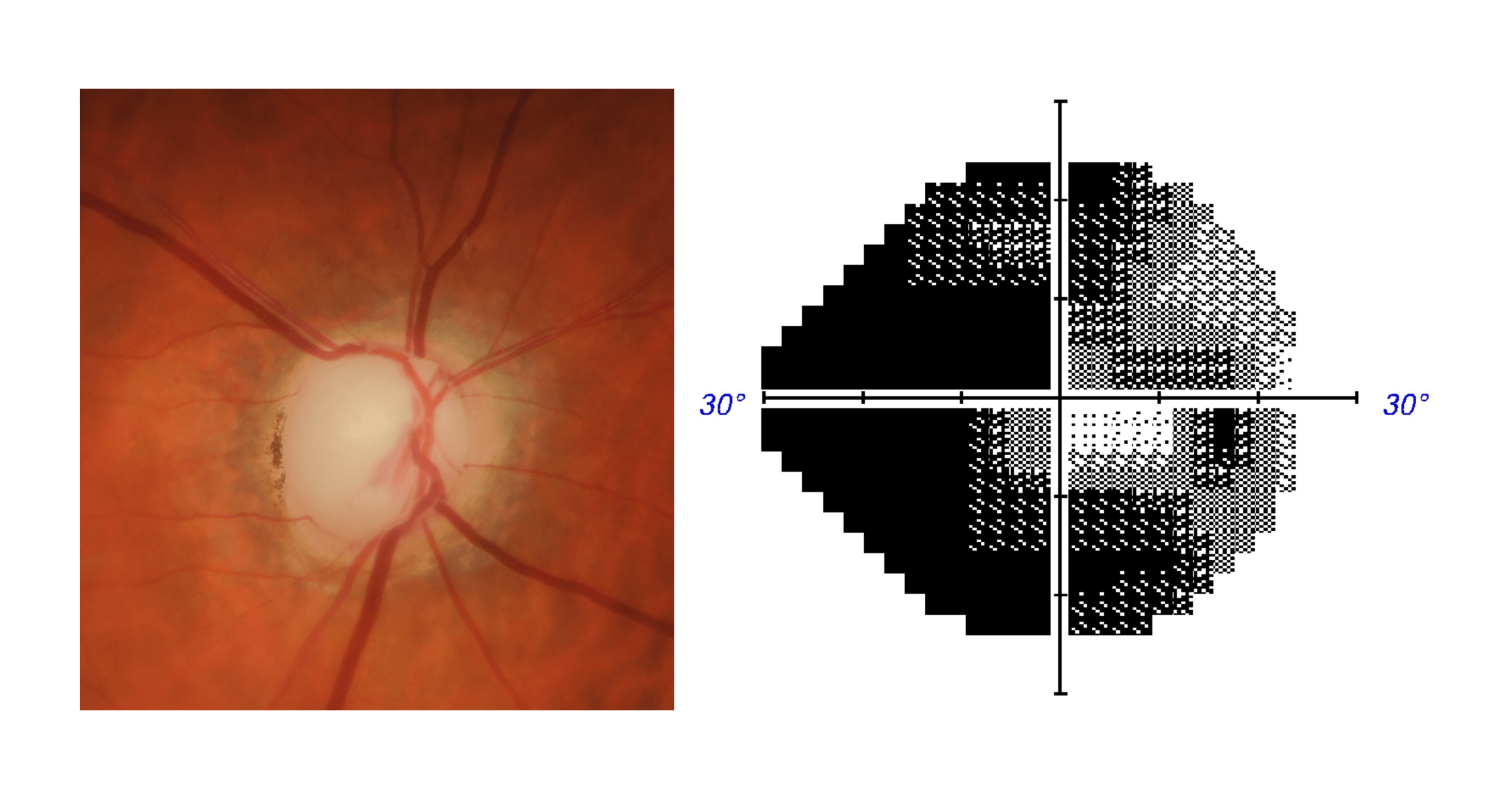 Optic nerve photo and visual field results for an eye with advanced glaucoma