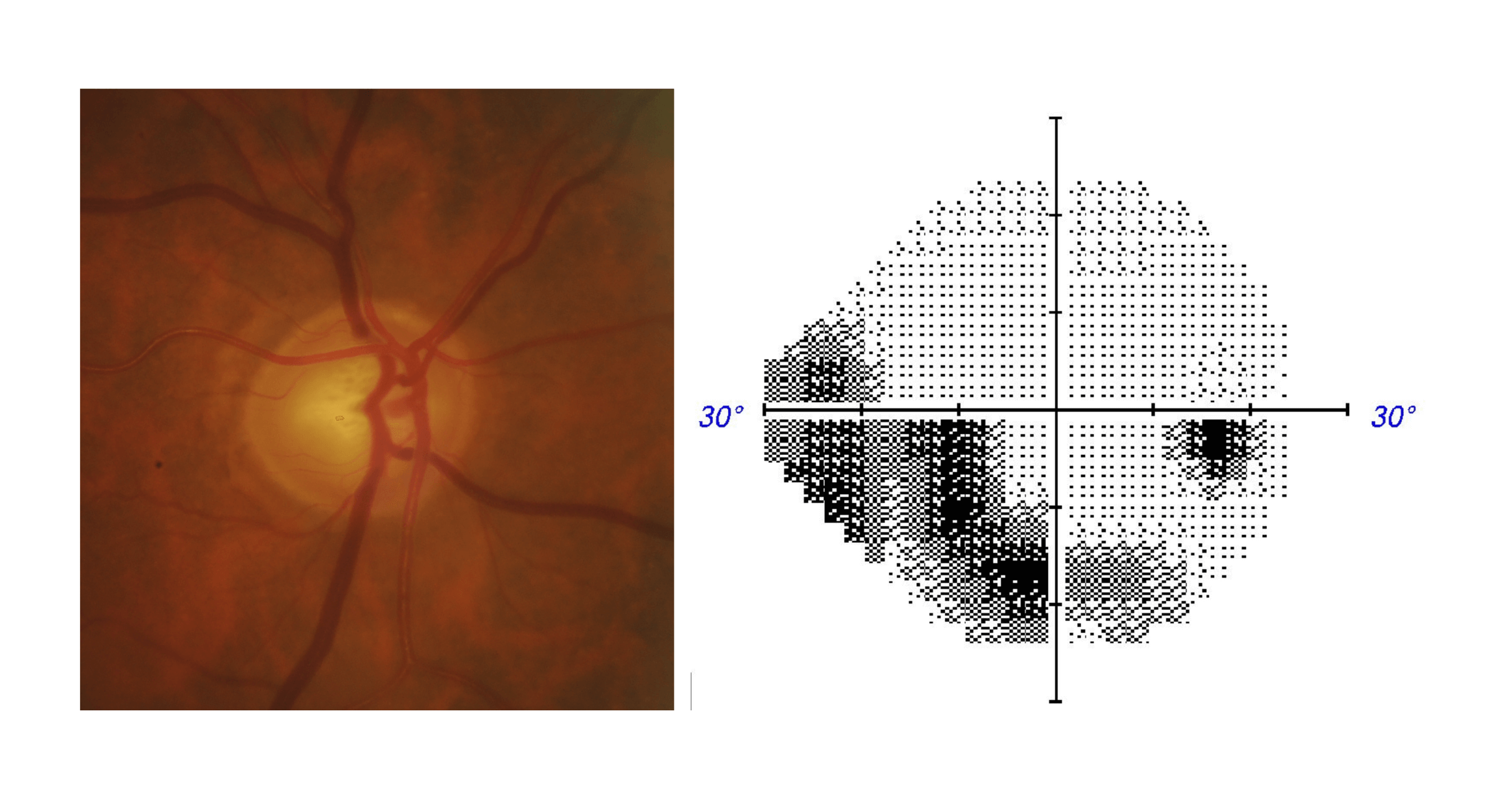 Optic nerve disc photo and visual field test results for an eye with moderate glaucoma