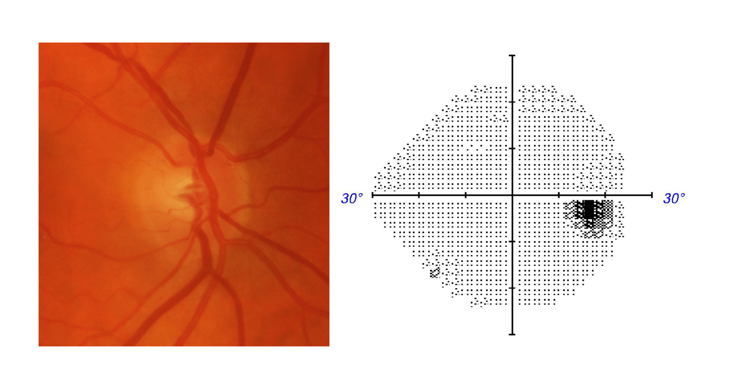 Optic disc photo and visual field test results for a normal eye without glaucoma