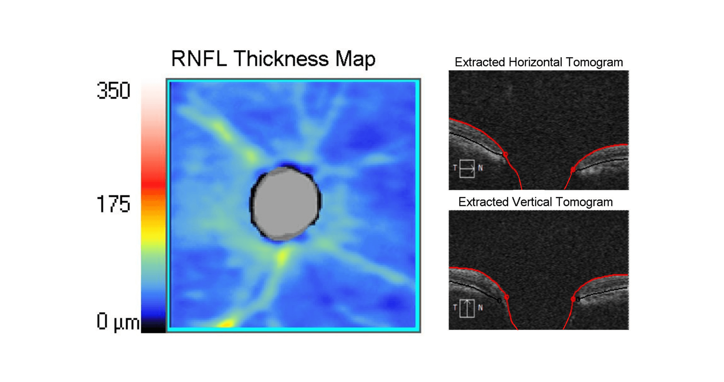 OCT scan results showing the retinal nerve fibre layer of an eye with advanced glaucoma