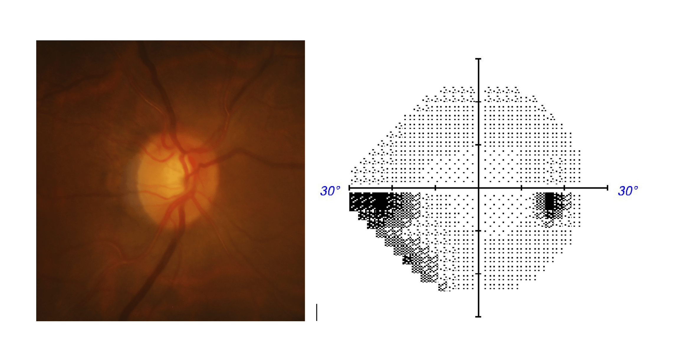 Stages Of Glaucoma Progression | Glaucoma Australia