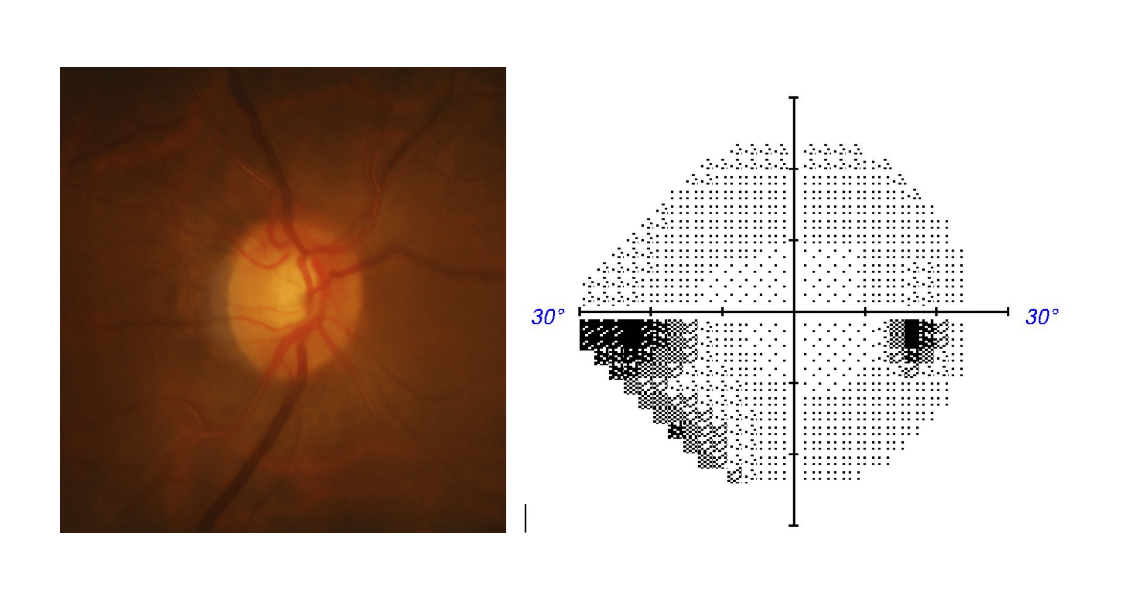 Optic disc photo and visual field test results for an eye with early stage glacuoma