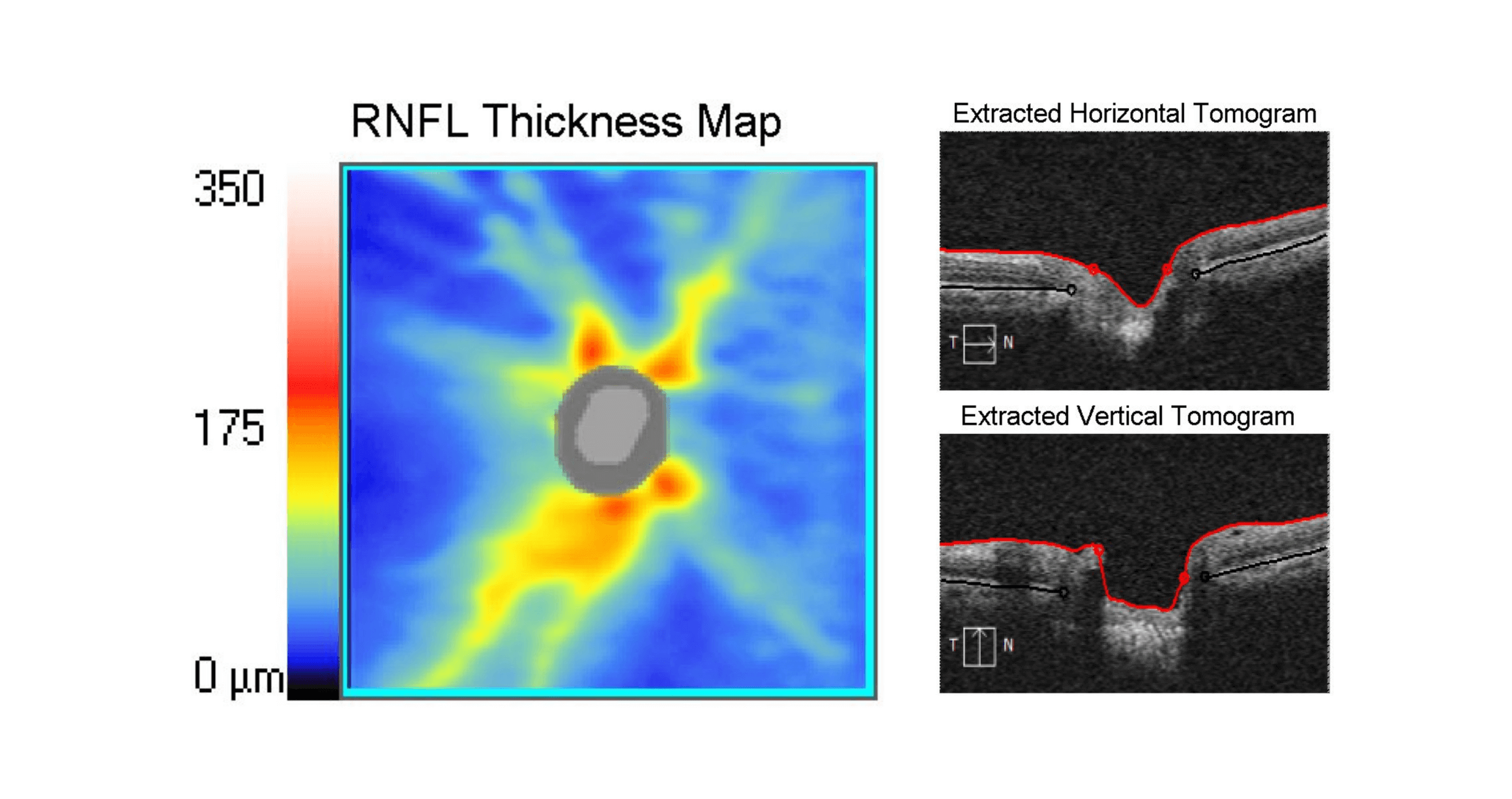 OCT scan results showing the Retinal Nerve Fibre Layer of an eye with early stage glacuoma