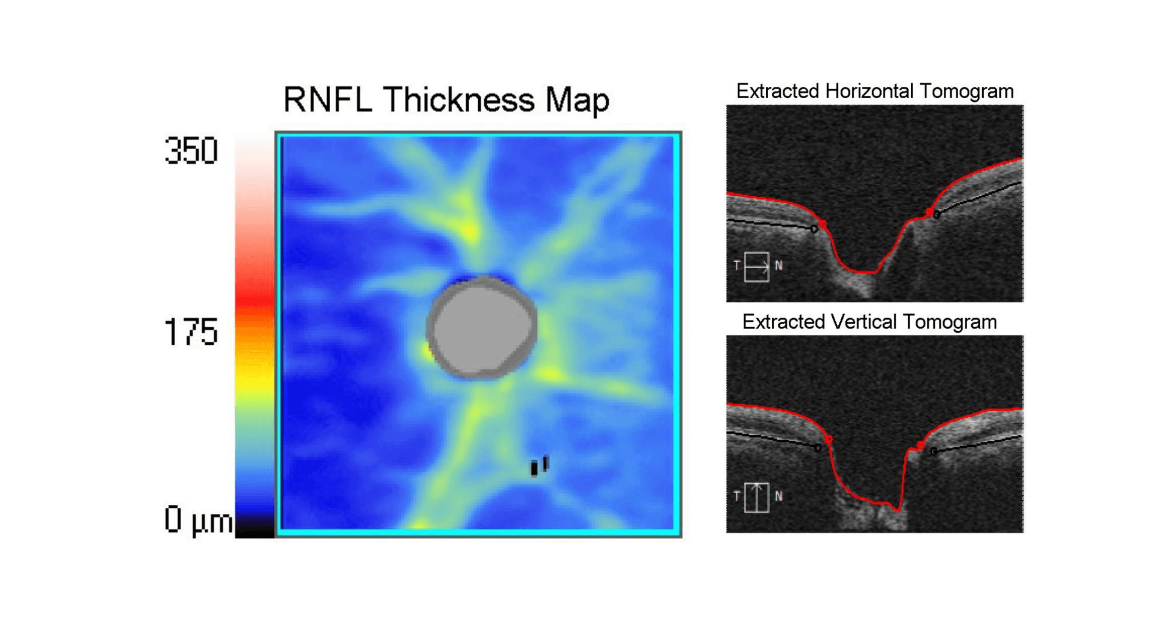 OCT scan results showing the retinal nerve fibre layer of an eye with moderate glaucoma