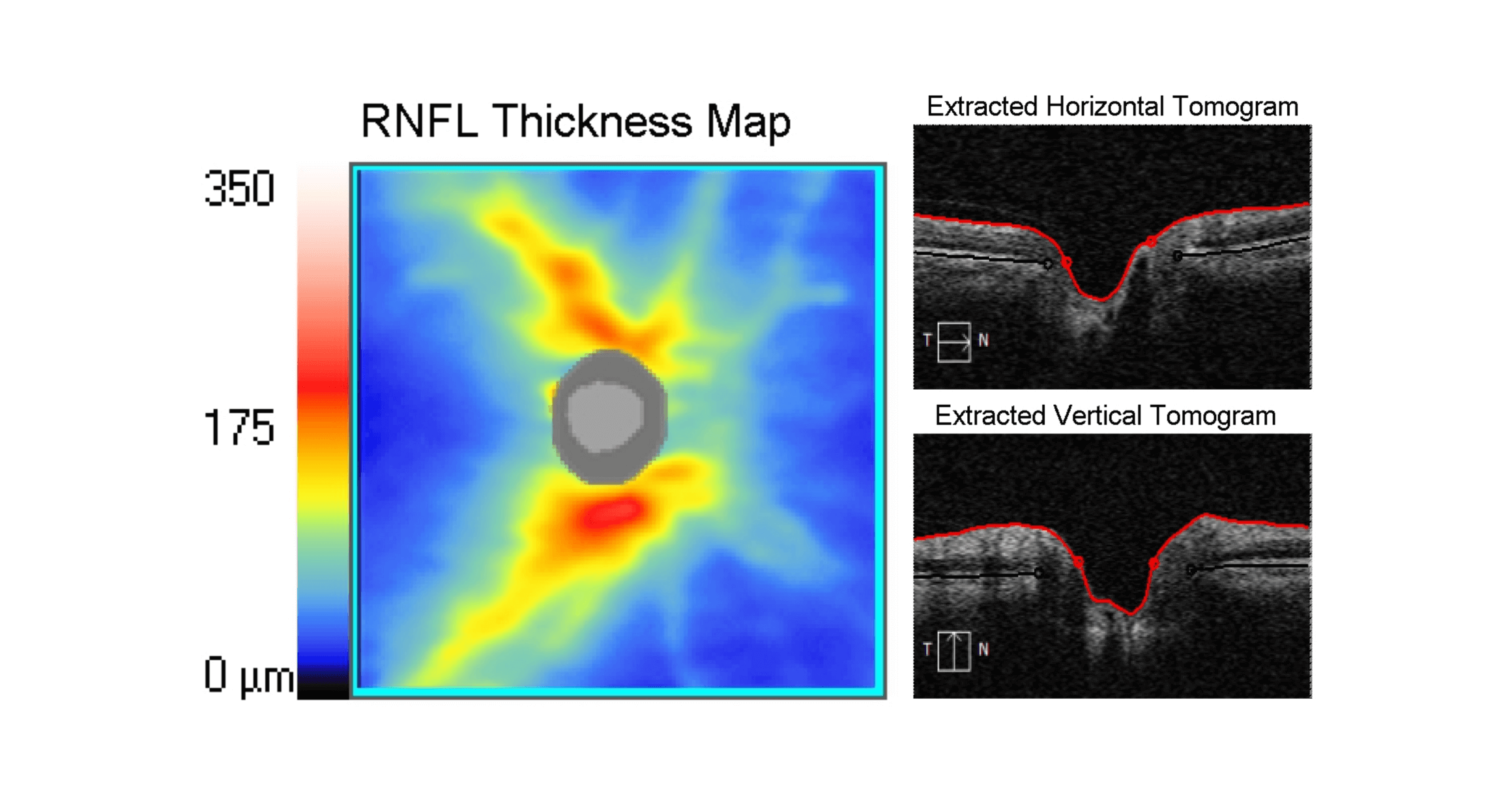OCT test results showing the Retinal Nerve Fibre Layer (RNFL) of an eye without glaucoma